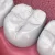 Types Of Restorative Fillings You Must Be Aware Of