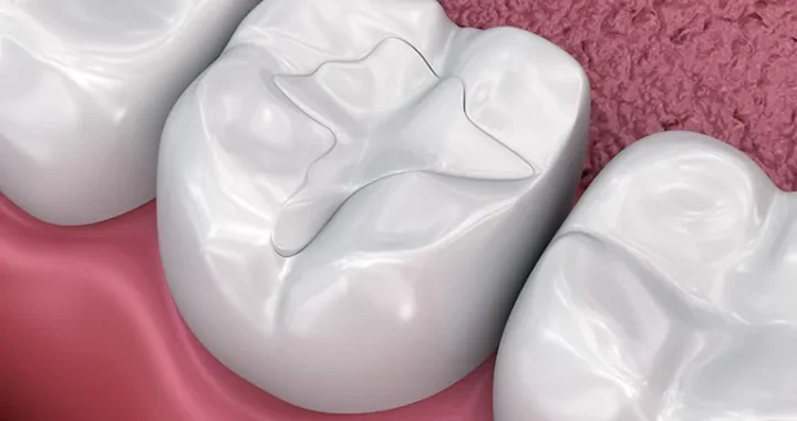 Types Of Restorative Fillings You Must Be Aware Of