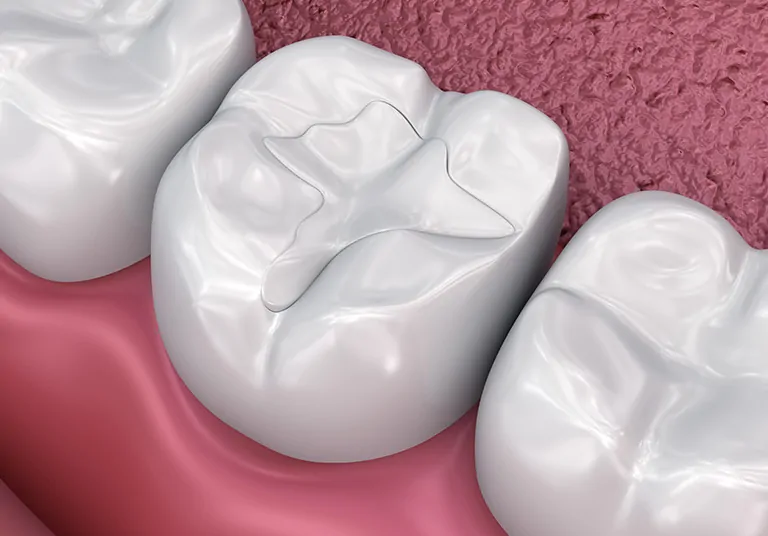 Types Of Restorative Fillings You Must Be Aware Of